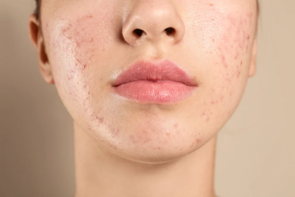 Acne Scars and Skin Resurfacing