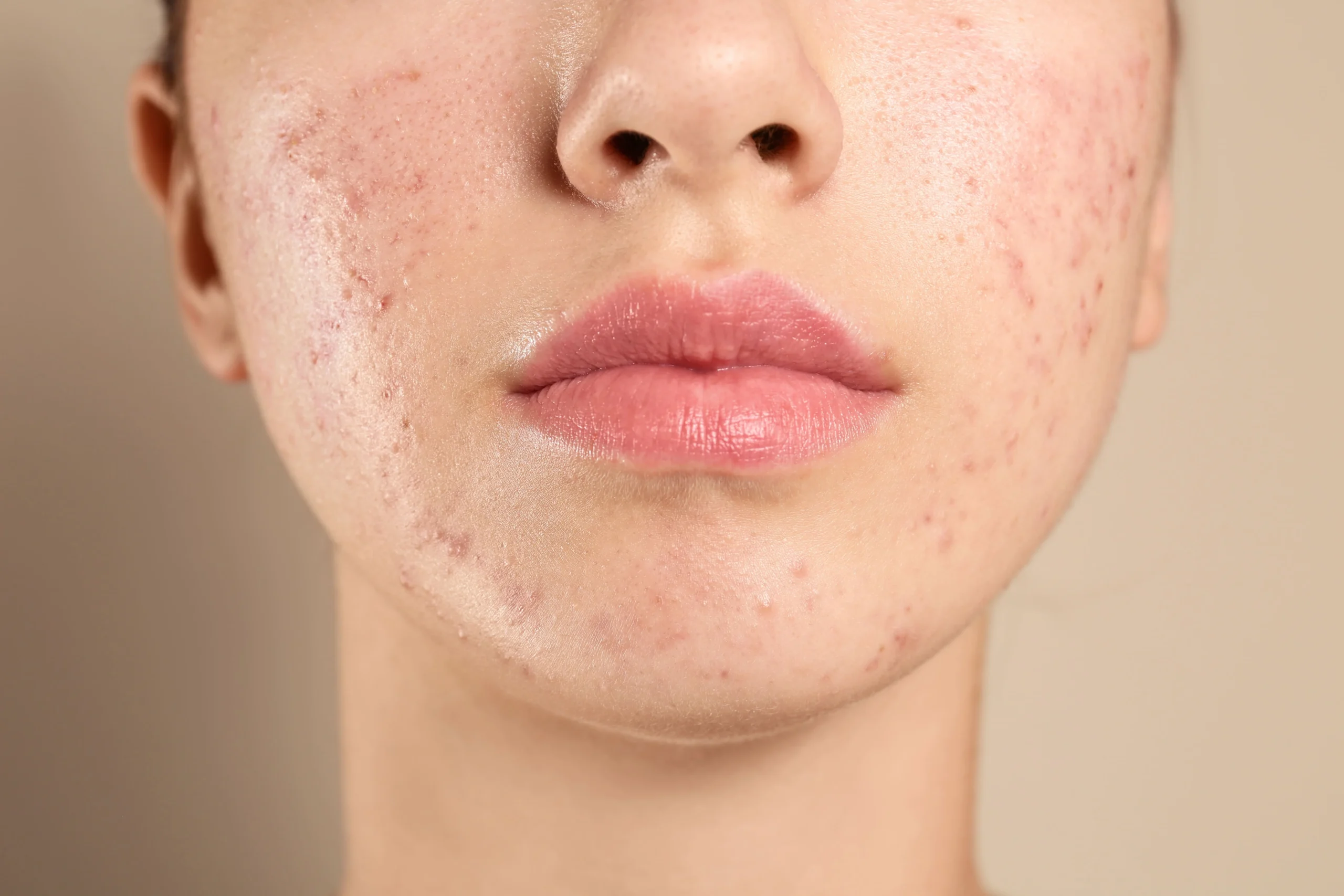 Acne Scars and Skin Resurfacing