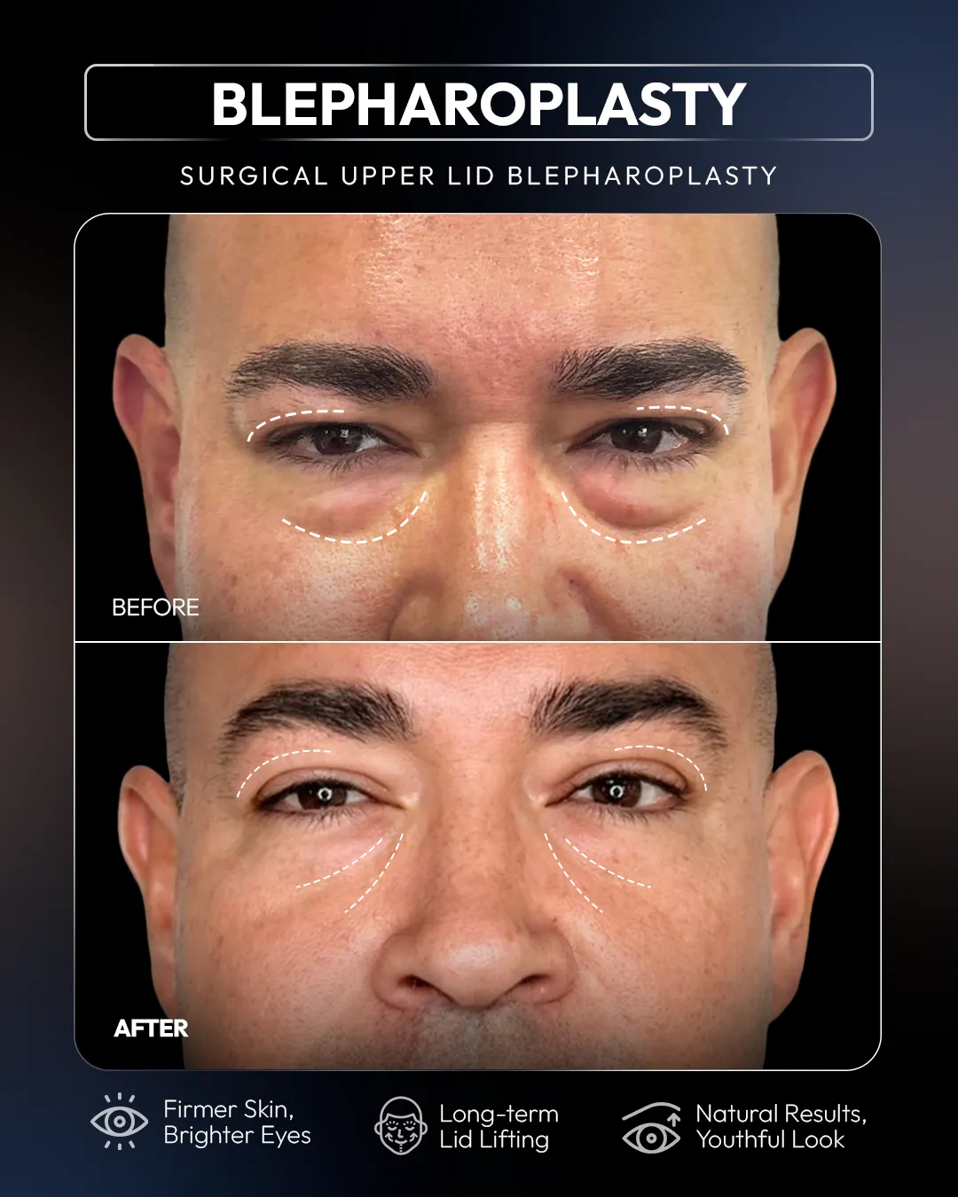 Surgical Blepharoplasty