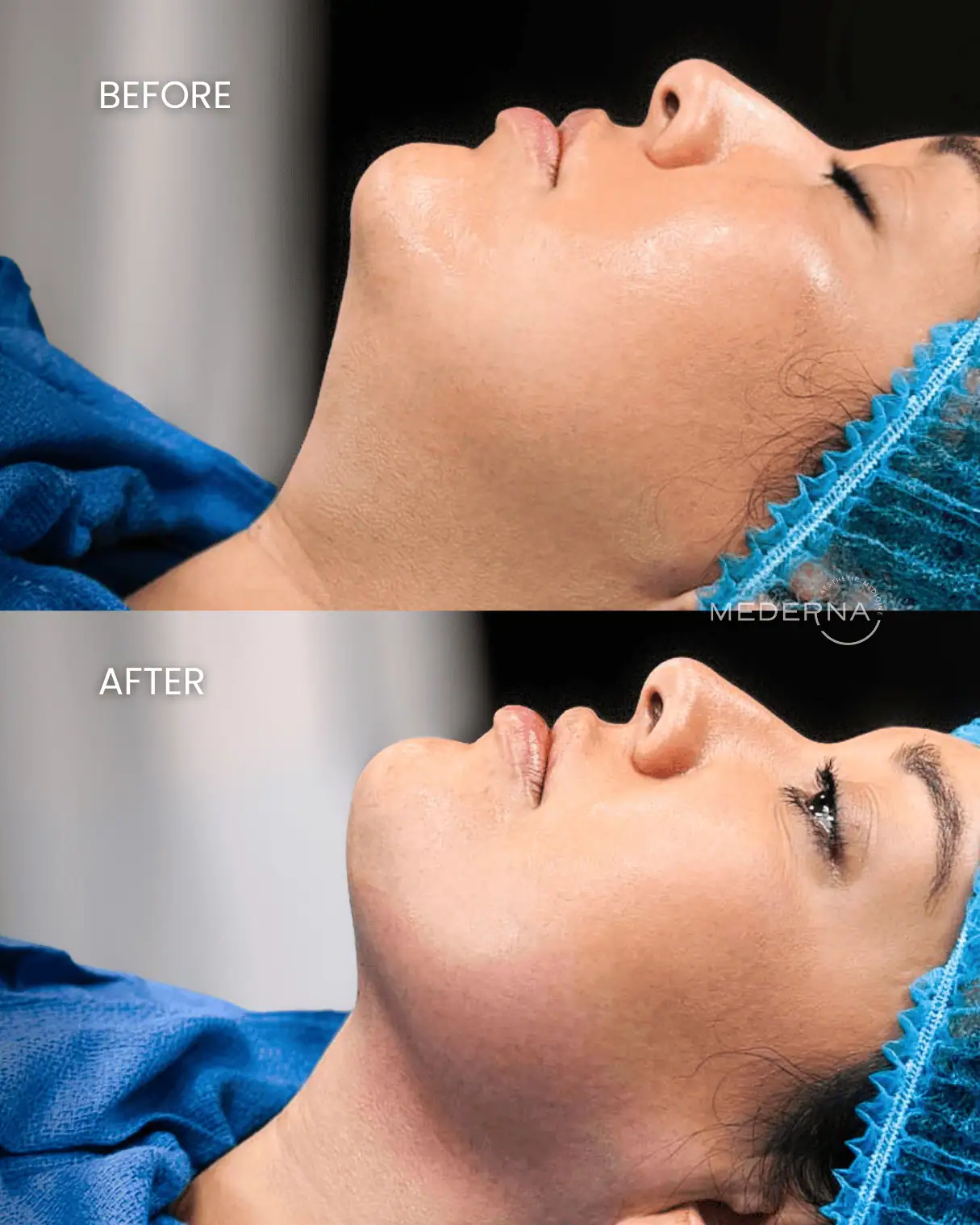 I-Laser-Sculpting-Before-after