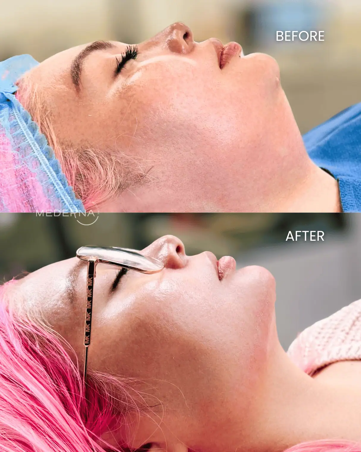 I-Laser-Sculpting-Before-and-after