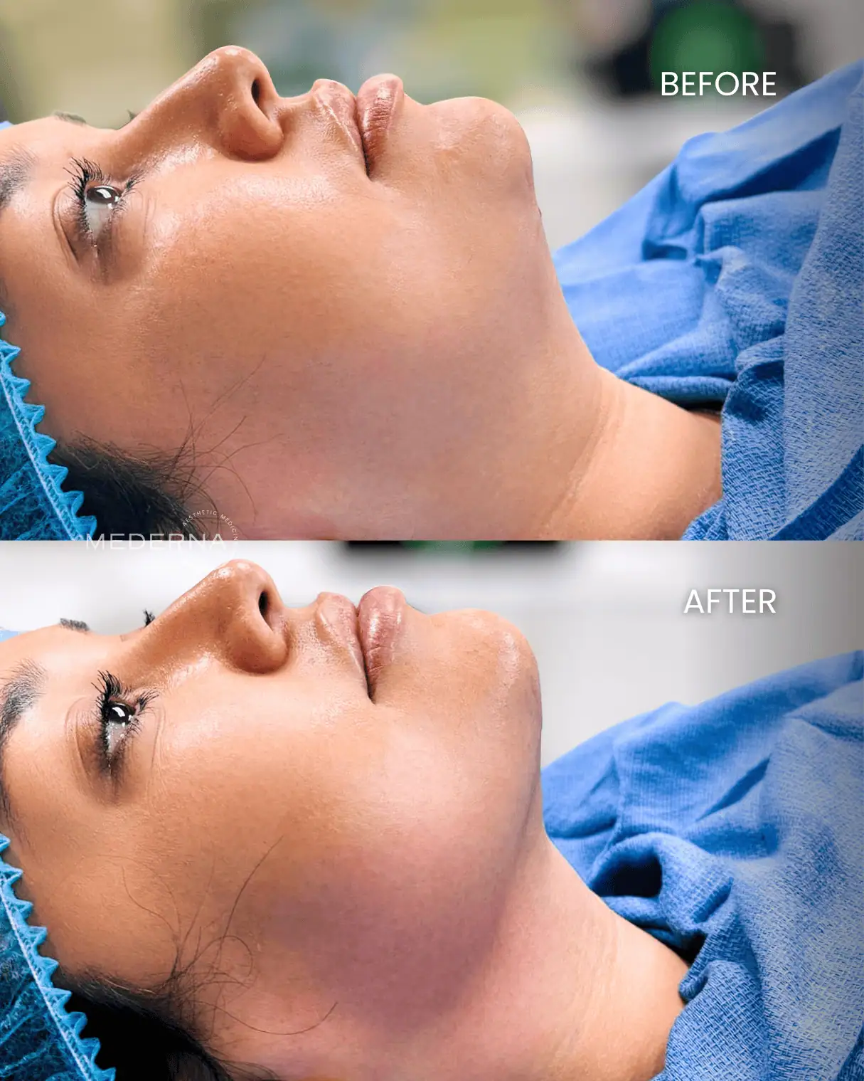 I-Laser-Sculpting-Before-and-afters