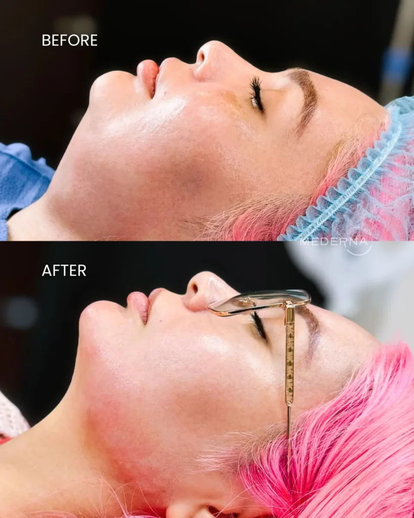 CHIN-LIPOSUCTION-BEFORE-AFTER-TRANSFORMATIONS