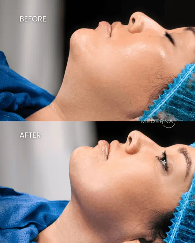 How Many Sessions of I-Laser Do You Really Need