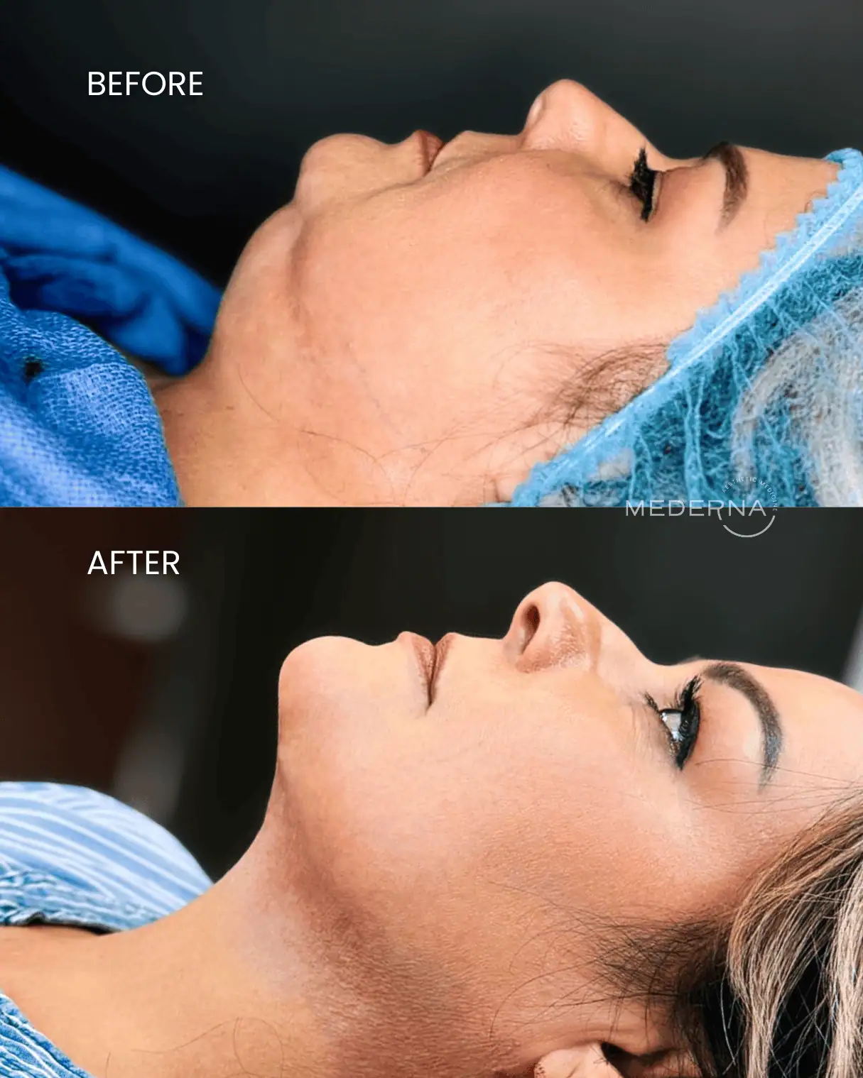 I-Laser Before & After